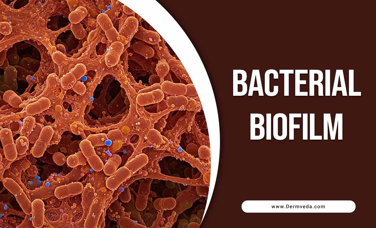 Bacterial Biofilm
