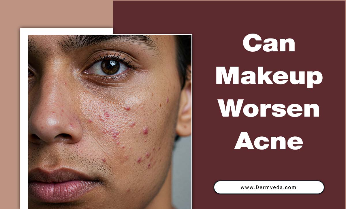Can Makeup Worsen Acne