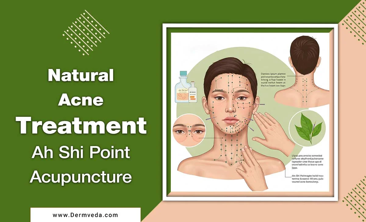 Natural Acne Treatment: Ah Shi Point Acupuncture