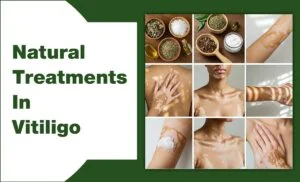 Natural Treatments In Vitiligo