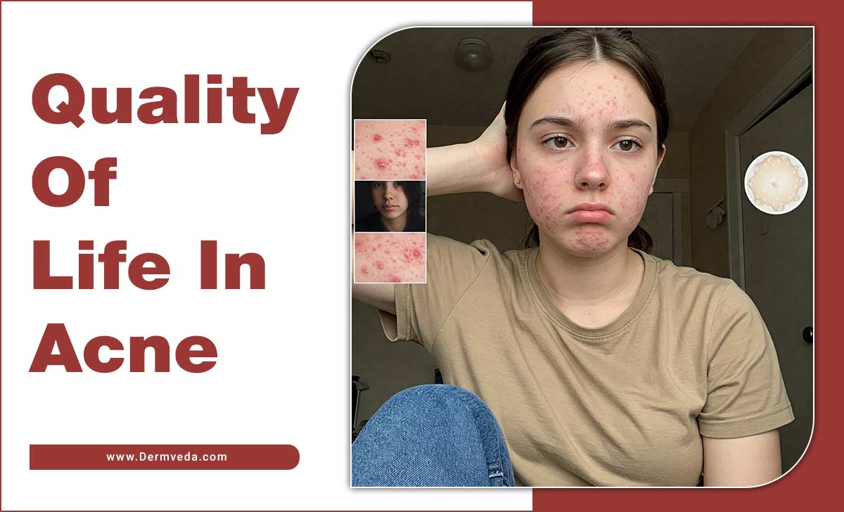 Quality Of Life In Acne