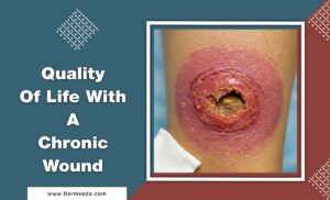 Quality Of Life With A Chronic Wound