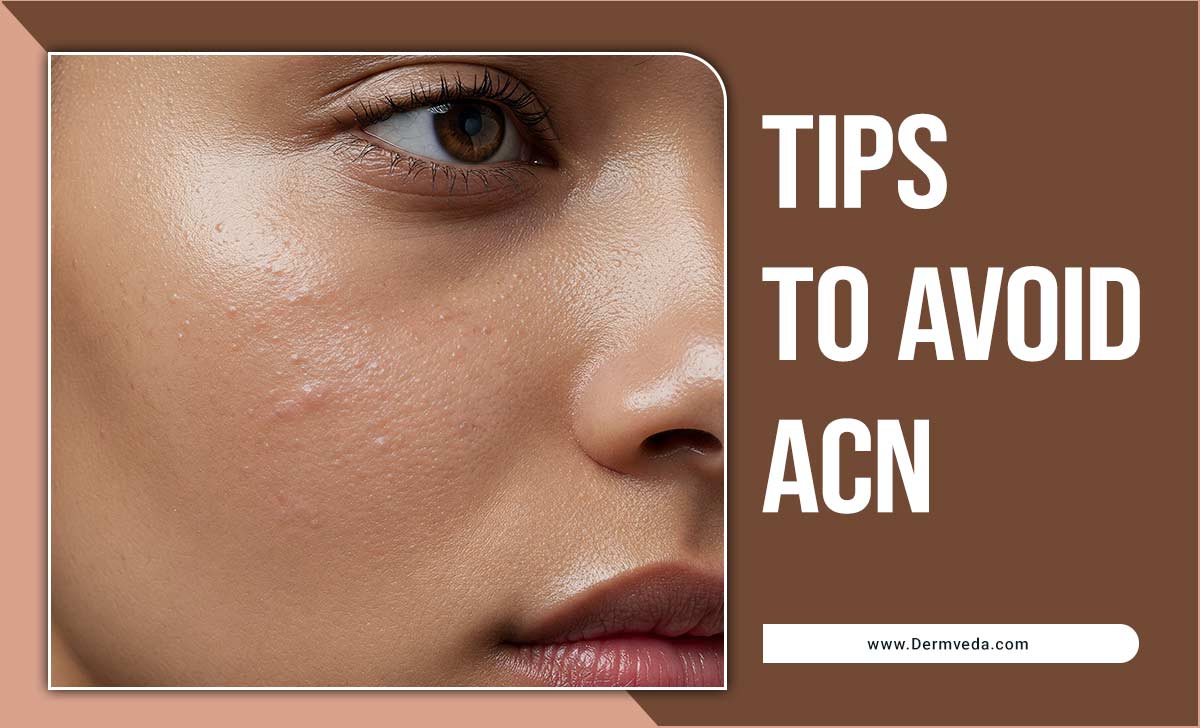 Tips to Avoid Acne
