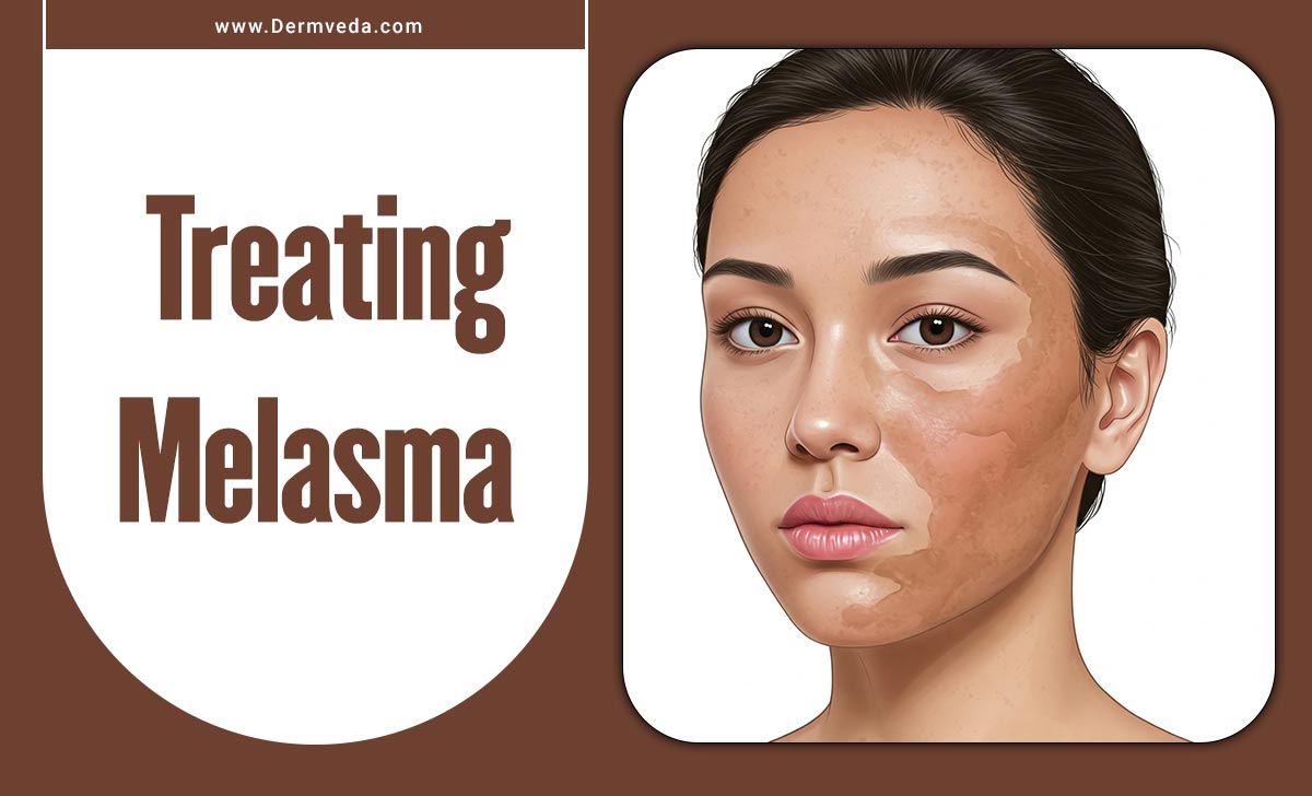 Treating Melasma