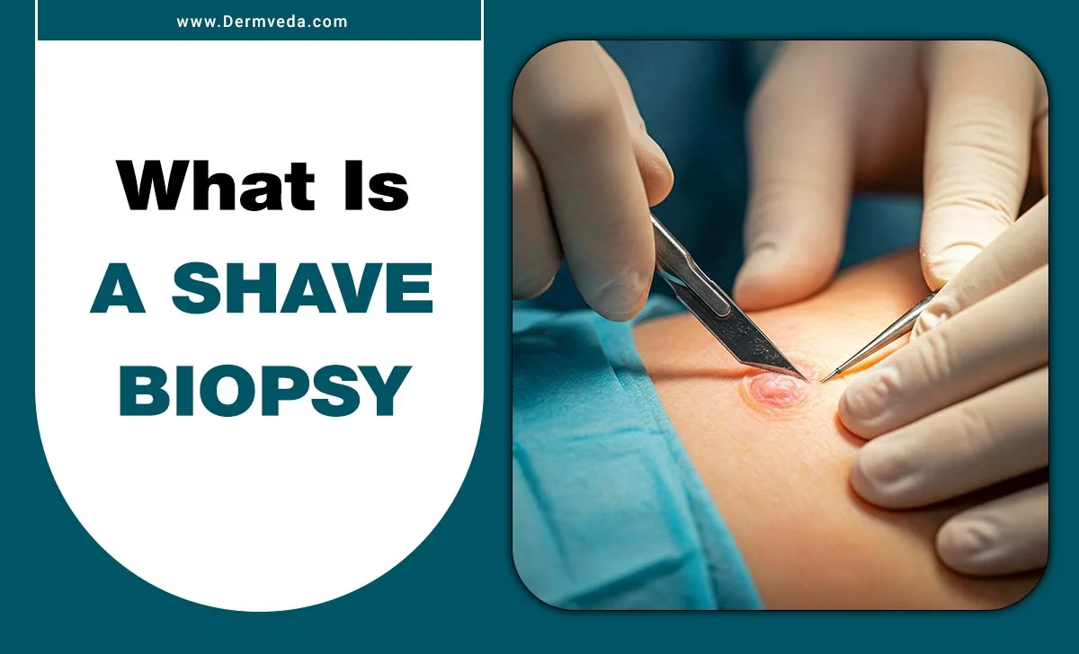 What Is A Shave Biopsy